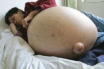 giant-tumor.jpg