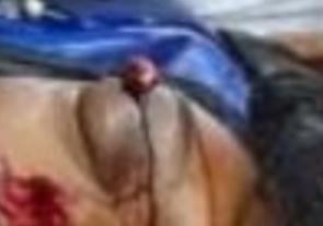 exit%20wound.JPG