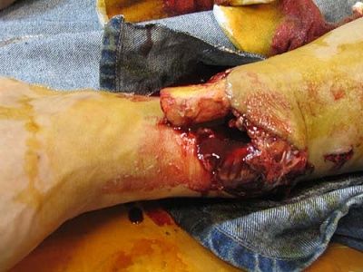fracture-1.jpg