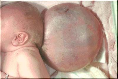 042encephcele.jpg