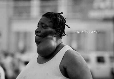 goiter.jpg