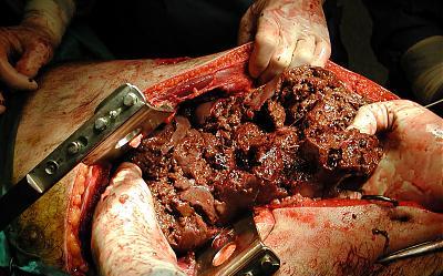 Exploded_Liver.jpg