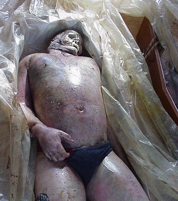 machete-wound-499x509.jpg