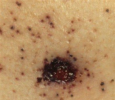 medium%20range%20-%20stippling%20no%20soot%20-%201%20to%203%20feet.jpg