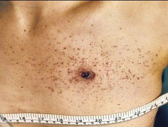 chest-stippling.jpg