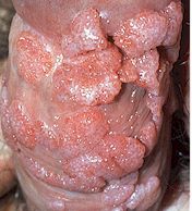 genital_warts.jpg