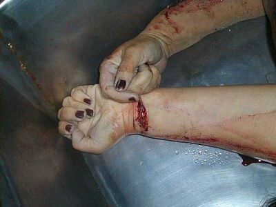 antebrazo-izquierdo.jpg