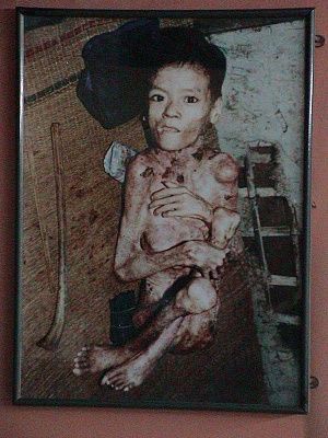 typical-victim-agent-orange-defoliant.jpg