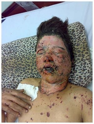 pic-6-white-phos-burned-body-02202009.jpg