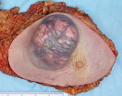breastcancer.jpg