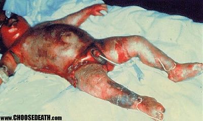 baby-burns.jpg