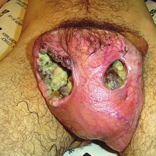 Extensive-necrosis-on-the-right-hemiscrotum_Q320.jpg