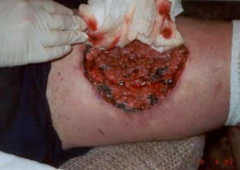 brown-recluse-spider-bite-9days.jpg