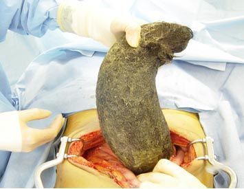 102122d1257720055-hair-eating-woman-gets-10-pound-hairball-2911244.jpg