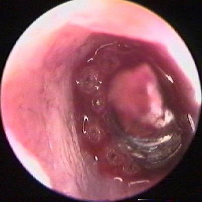 20030906-ear-maggots-10c.jpg