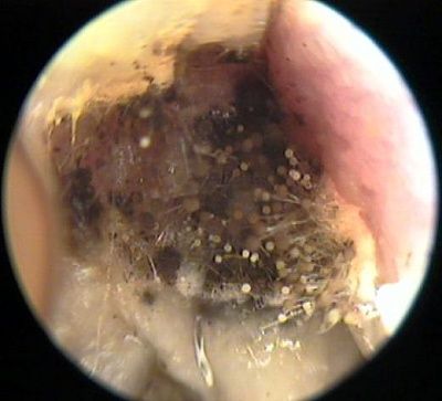 otomycosis_090601.jpg