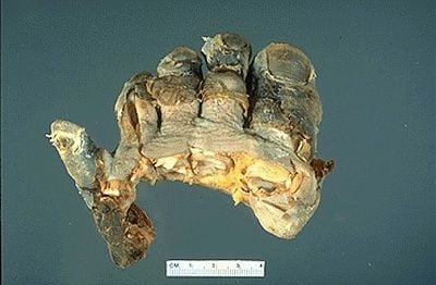 gangrene1.jpg
