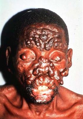 leprosy1.jpg