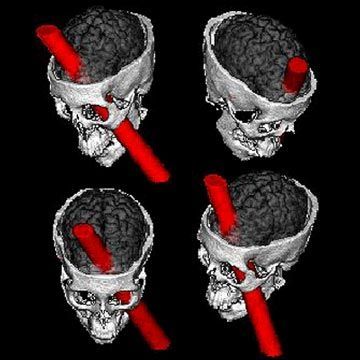phineas_gage_from_uiowa_d_neurology.jpg