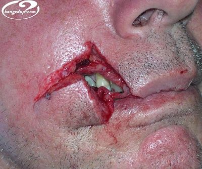 lacerationface003.jpg
