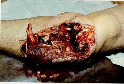 skinned-20knee.jpg
