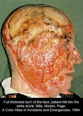 faceburn.jpg