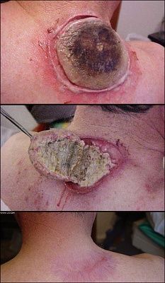 neck_lesion.jpg