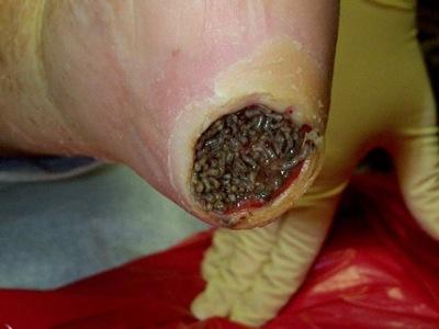 maggot-therapy.jpg