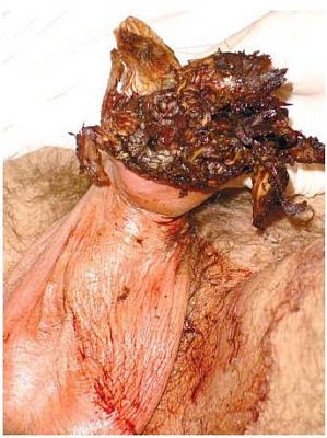 penectomy-1.jpg