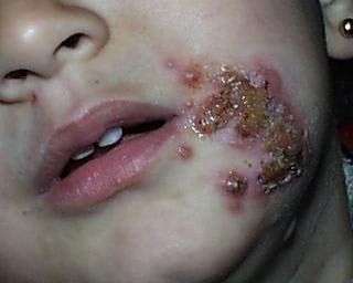 Herpes Simplex Infections: Eczema Herpeticum, Cold Sores and Genital Herpes - attached file 6