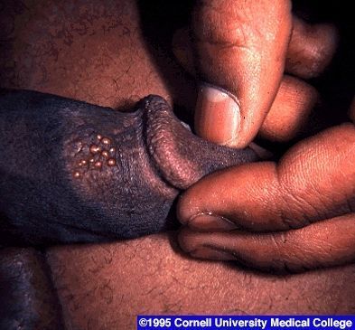 Herpes Simplex Infections: Eczema Herpeticum, Cold Sores and Genital Herpes - attached file 34