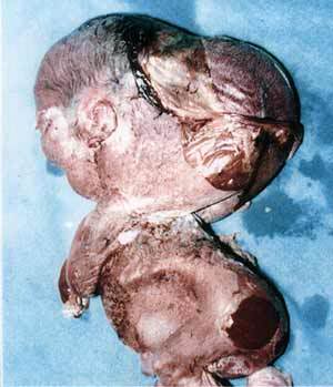 hydrocephalus.jpg