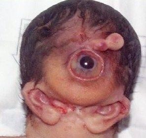 cyclopsbaby.jpg