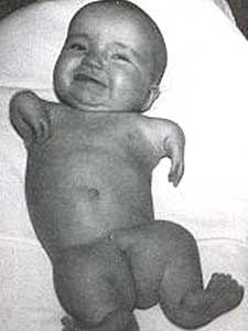 20060321_thalidomidebaby_3.jpg