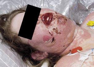Toxic%20epidermal%20necrolysis%20syndrome.jpg