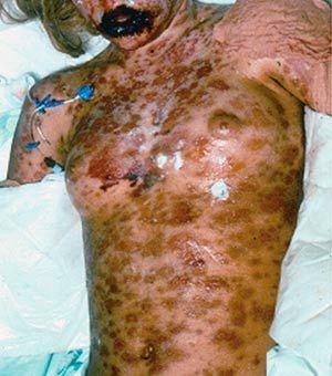 Toxic%20epidermal%20necrolysis%20syndrome3.jpg