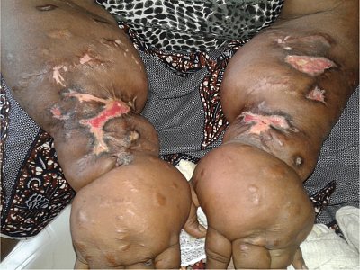 nigerianjplastsurg_2020_16_2_83_303837_f1.jpg
