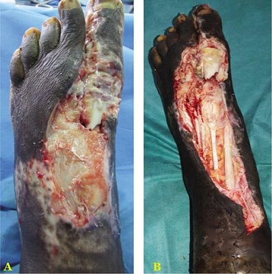 nigerianjplastsurg_2019_15_2_44_290020_f1.jpg