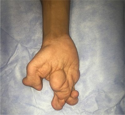 nigerianjplastsurg_2018_14_2_45_246152_f1.jpg