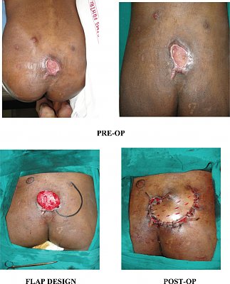 nigerianjplastsurg_2018_14_2_28_246157_f1.jpg