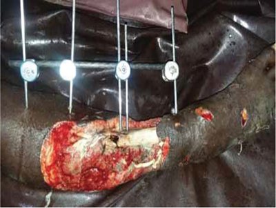 nigerianjplastsurg_2018_14_1_5_238812_f1.jpg