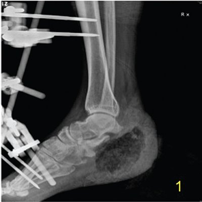 nigerianjplastsurg_2017_13_1_28_213033_f1.jpg