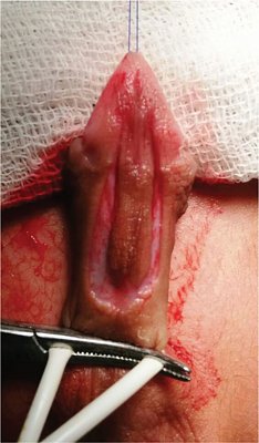 nigerianjplastsurg_2017_13_1_12_213028_f1.jpg