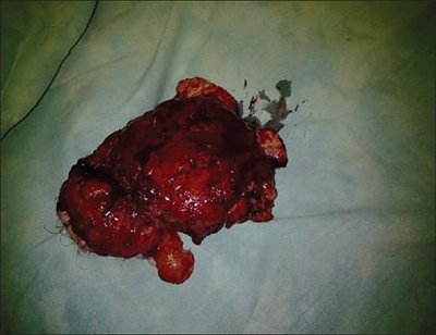 nigerianjplastsurg_2015_11_2_68_178453_f2.jpg