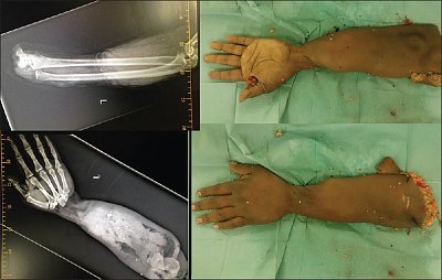nigerianjplastsurg_2015_11_2_63_178451_f1.jpg