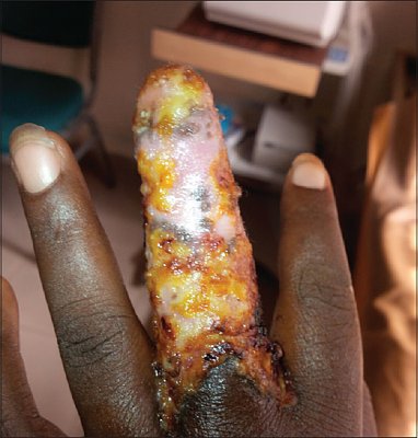 nigerianjplastsurg_2015_11_2_59_178452_f1.jpg