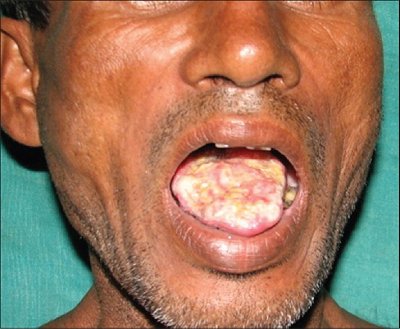 nigerianjplastsurg_2015_11_2_40_178454_f1.jpg