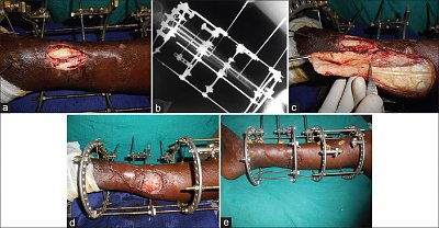 nigerianjplastsurg_2015_11_2_45_178450_f1.jpg