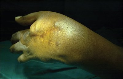 nigerianjplastsurg_2015_11_1_29_166849_f1.jpg