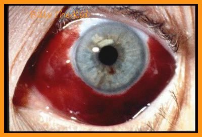 festered_eyes004.jpg